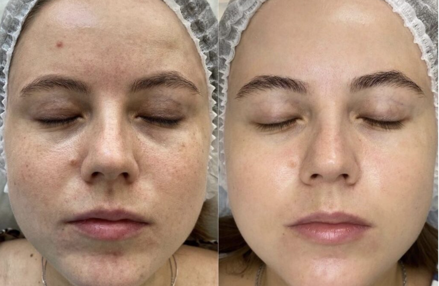 PRX-T33 (CelluGlow) inkl. eftervårdsprodukter