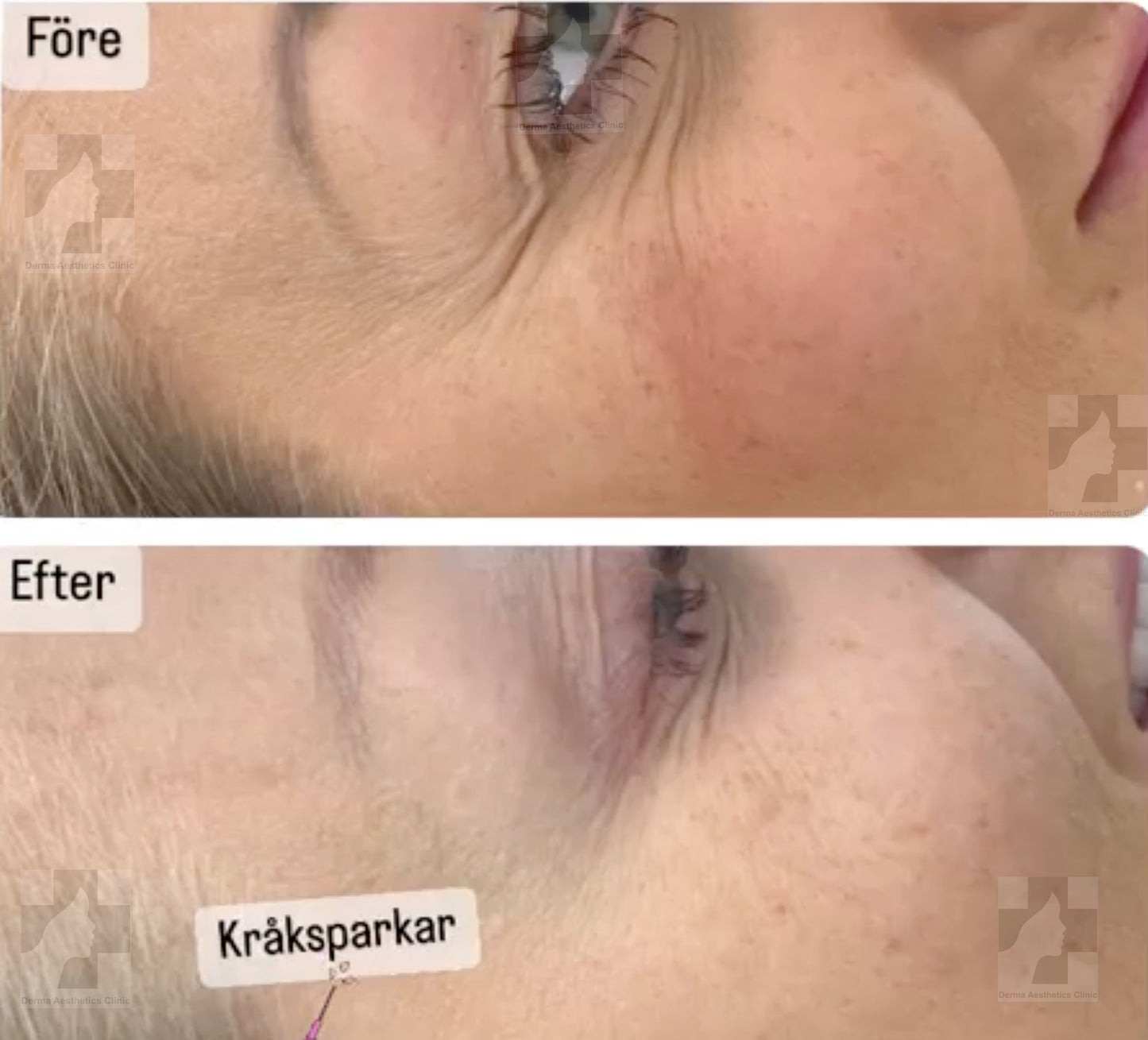 Botox injektionsresultat före och efter