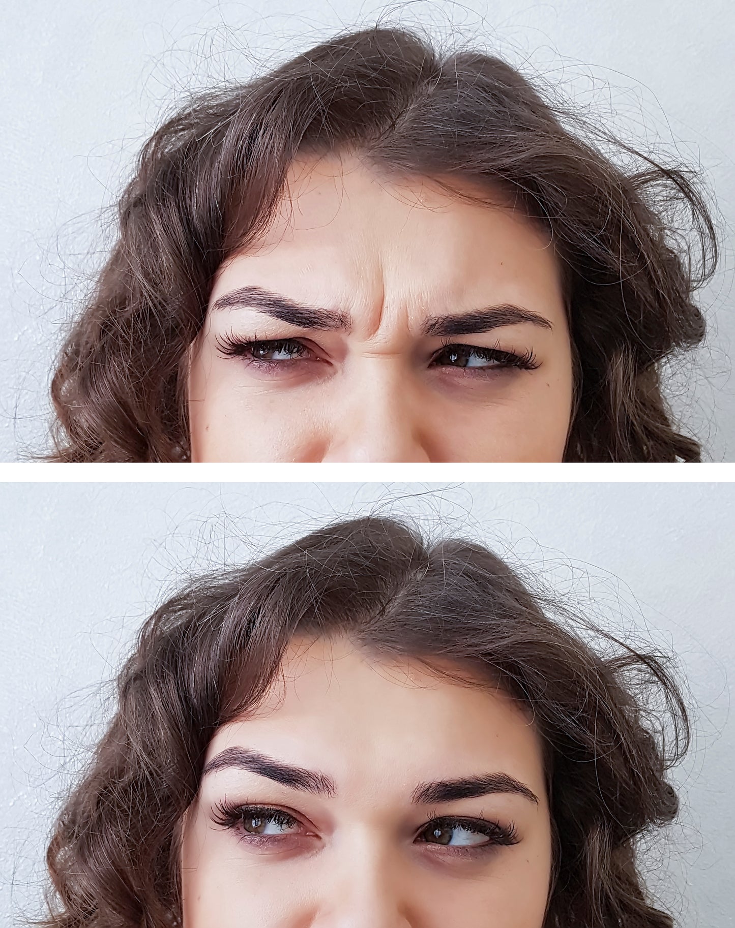 Botox resultat före och efter